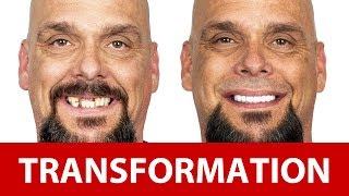 Greg's All-on-4 Dental Implants Transformation Story