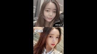 자연주의성형외과 쌍수+코재수술 수술전후 영상
