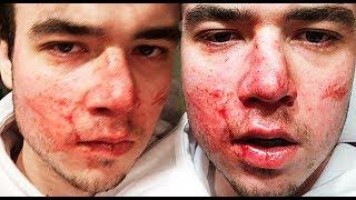 I got jumped... (broken nose)