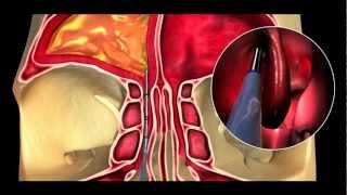 Balloon Sinus Dilation Animation