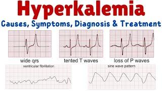 Hyperkalemia (High Potassium) – Causes, Symptoms, Diagnosis and Treatment