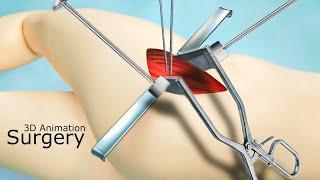 Hip Replacement Surgery : 3D Animation | The Scopic Vision