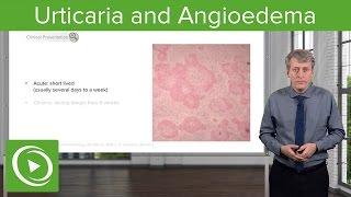 Urticaria (Hives) and Angioedema – Pediatrics | Lecturio