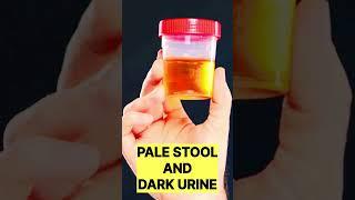 8 WARNING SIGNS OF FATTY LIVER |Dr.Sujeet Gupta|      #shorts #facts #fattyliver #reels