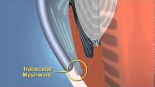 Closed Angle Glaucoma