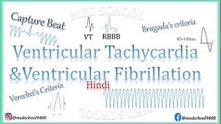 Ventricular Tachycardia and Ventricular Fibrillation Hindi