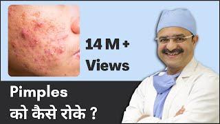 Pimples को कैसे रोके (How to Prevent Pimples) | 2023 | ClearSkin, Pune | (In HINDI)