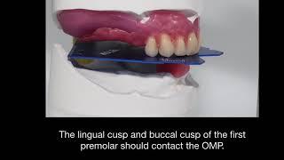 Setting Up Upper Denture Teeth