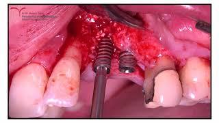 Implant Placement and GBR ( Allograft & Collagen membrane) by Dr Bernard Dahan