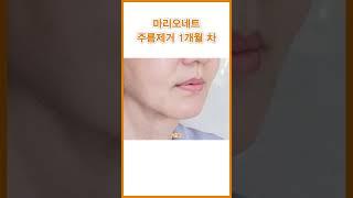 마리오네트주름 1개월차 측면 전후비교 #short #마리오네트 #마리오네트주름 #입가주름 #입가처짐 #중년리프팅 #얼굴처짐 #그림성형외과