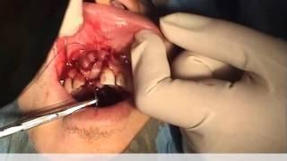 Implant placement with big fenestration