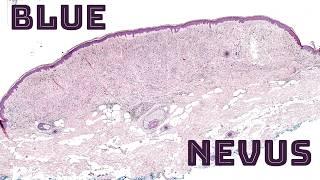 Blue Nevus under the microscope (blue/grey/black mole skin spot) pathology dermpath dermatology