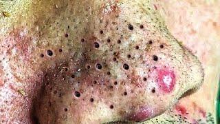 Big Cystic Acne Blackheads Extraction Blackheads & Milia, Whiteheads Removal Pimple Popping #20