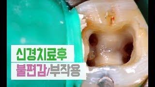 치아 신경치료후 불편감 / 부작용