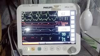 Broad QRS complex with irregular rhythm.