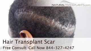 Hair Transplant Scar 2019 with Dr Kevin Blumenthal