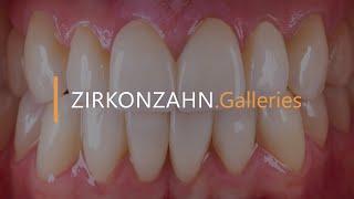 Minimally invasive restoration with ultra-thin zirconia veneers | Zirkonzahn.Galleries