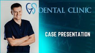 Dental Case Presentation GS DENTAL CLINIC 2023 #dentalcases , #dental , #clinicalcase , #dentalcare