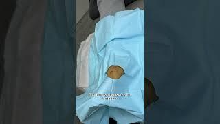 Removing Soft TISSUE Mass From FOOT!