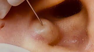 NEW Large Cyst Removal BEST POPS Compilation || w/ relaxing music & an OOZ GALORE!