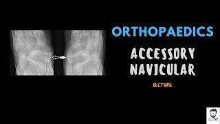 Accessory navicular Bone - Orthopaedics - Detailed Lecture