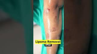 Lipoma Cure | Multiple Lipoma removal result