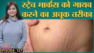 Skin पर पड़े Stretch Marks जा नहीं रहे तो Doctors की ये सलाह मानें   | Sehat ep 127