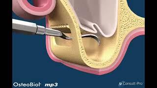 Синус лифтинг с MP3 OsteoBiol