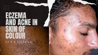 Eczema and acne in skin of colour