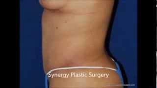 Abdominoplasty Before & After Photos from Real Patients of Synergy Plastic Surgery, Austin TX