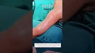 Arm liposuction immediate results #liposuctionresults Dr. Karishma Aesthetics Bengaluru