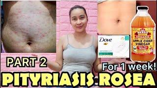 PITYRIASIS ROSEA (WHAT’S MY  STORY?) PHILIPPINES