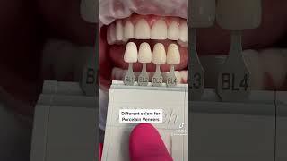 Porcelain Veneers Color Options #shorts #porcelainveneers #cosmeticdentistry #celebritysmiles #teeth