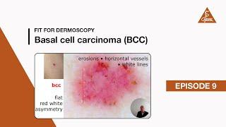 Fit for Dermoscopy Episode 9 – Basal Cell Carcinoma