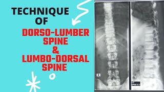 Technique of Dorso-Lumber & Lumbo-Dorsal Spine (Ep 65) | X-ray Thoraco-lumber spine ap & lat views