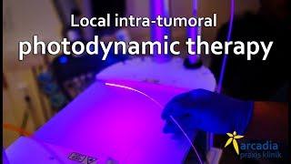 Local intra-tumoral PDT (photodynamic therapy)