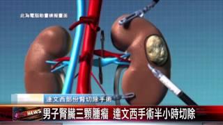 20150722 男子腎臟三顆腫瘤 達文西手術半小時切除