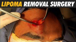 Forehead Lipoma removal | Permanent lipoma cure