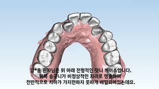 D1 Dental 디원치과 아미절라인 AMIsalign 투명교정 김*훈님 케이스리포트