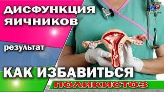 Coral Club Расстройство гормональной функции яичников Дисфункция яичников Как от нее избавиться