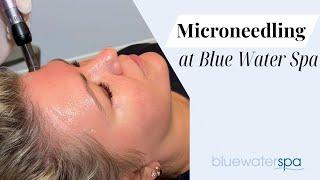 Microneedling at Blue Water Spa || Blue Water Spa Raleigh