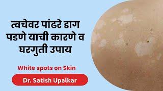 त्वचेवरील पांढरे डाग जाण्यासाठी घरगुती उपाय : डॉ सतीश उपळकर | White spots on Skin home remedies