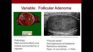 Thyroid Nodules  What We Know and What We Don't Ultrasound Video