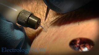 Follicle Extractions