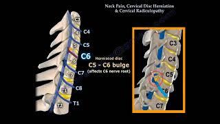 "Neck Pain, Cervical Disc Herniation, and Radiculopathy: Causes, Symptoms, and Treatment"