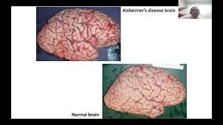 AANP Teaching Rounds - September 26 - Alzheimer's Disease and Common Co-Morbidities