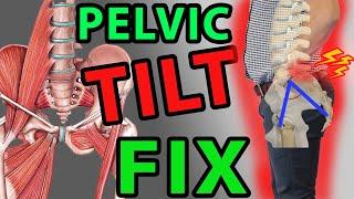 Best Fix Anterior Hip Tilt 1 Minute Exercises | Pelvic Tilt