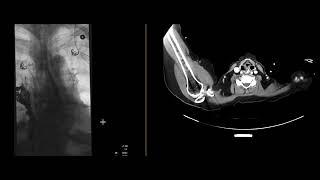 Esophageal Perforation