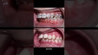 Niềng răng hô 24 tháng #braces #orthodontist #niengrang