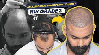 Hair Transplant in Ahmedabad | Best Results & Cost of Hair Transplant in Ahmedabad